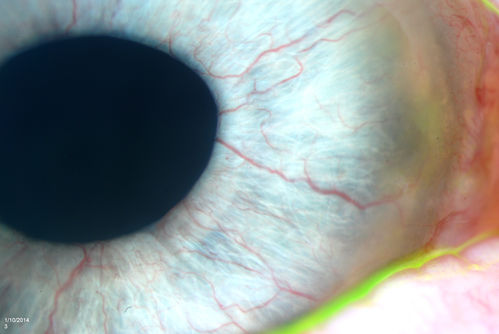 Neovascularization, Rubiosis
Patient comes in for GPCL fitting. VA is 20/50 w/GPCL. Slit lamp photography shows neovascularization on the iris in the right eye. Also iris atrophy, superiorly in the right eye.
Keywords: January2014