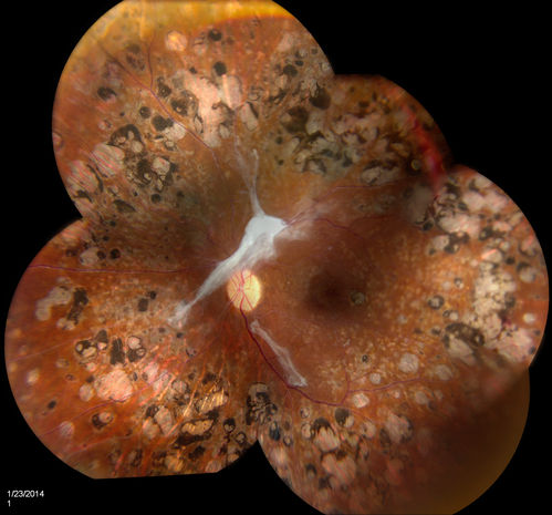 Proliferative Diabetic Retinopathy
Fundus photography shows severe fibrosis and arterial narrowing. Peripheral laser scars in both eyes. VA is 20/40, right eye and 20/50, left eye. 
Keywords: February2014