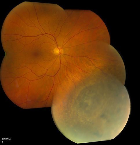 Choroidal Nevus
Fundus exam shows choroidal nevus, inferior nasally in the right eye. VA is 20/40 in the right eye. BSCAN shows nevus is 2mm thick with no orange pigment. Will be reevaluated in 3-months
