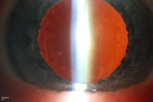Pseudoexfoliation Material Peeling.
Patient comes in for regular eye exam. Last exam was 8-years ago. Complains of decrease in VA. VA was 20/30, right eye and 20/40, left eye. Slit lamp photography shows pseudoexfoliation peeling of the lens within 360-degrees. Pseudoexfoliation ring is present centrally. IOP was normal. Will revisit in 3-months for follow up.
