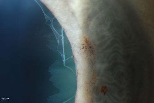 Pseudoexfoliation Material Peeling.
Patient comes in for regular eye exam. Last exam was 8-years ago. Complains of decrease in VA. VA was 20/30, right eye and 20/40, left eye. Slit lamp photography shows pseudoexfoliation peeling of the lens within 360-degrees. Pseudoexfoliation ring is present centrally. IOP was normal. Will revisit in 3-months for follow up.
