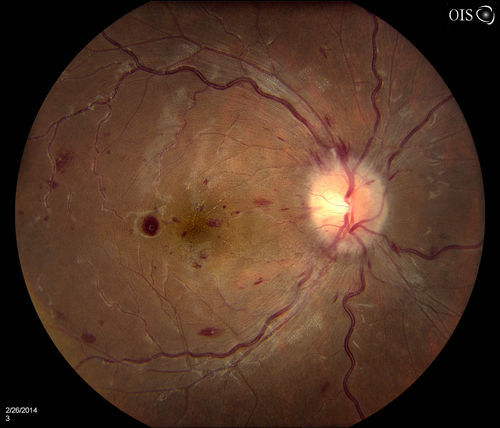 Optic Nerve Edema with Retinal Hemorrhages.
Female patient diagnosed with lupus a year ago, comes in with spot and decreased vision in the right eye. VA is 20/400 in the right eye and 20/40, in the left eye. Fundus photography shows multiple retinal hemorrhages and possible bilateral papilledema. 
Keywords: february2014