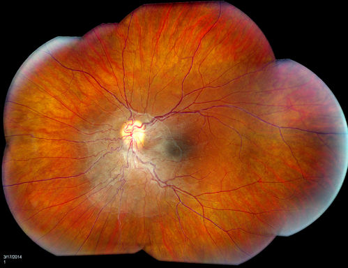 Epiretinal Membrane
Patient with a history of pars planitis comes in with decreased vision in the left eye. VA is 20/30 in the left eye. Fundus photos show a rather large epiretinal membrane covering the optic nerve in the left eye. 
