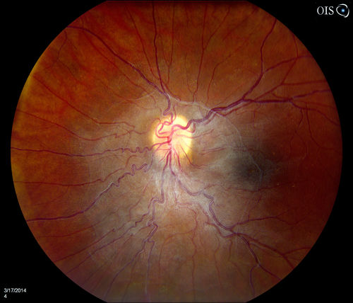 Epiretinal Membrane
Patient with a history of pars planitis comes in with decreased vision in the left eye. VA is 20/30 in the left eye. Fundus photos show a rather large epiretinal membrane covering the optic nerve in the left eye. 
