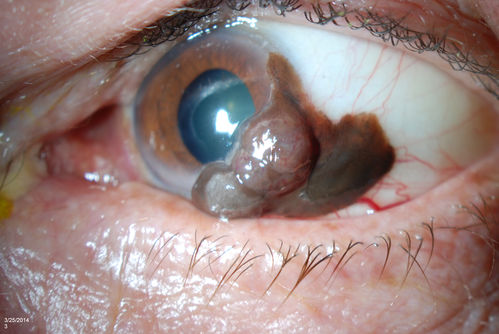 Conjunctival Melanoma
Patient comes in with a conjunctival melanoma in the left eye. Patient states that melanoma grew rather quickly in just a few weeks. Will proceed with biopsy to confirm findings. 
