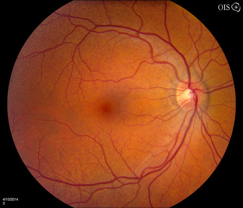 Pseudoxanthoma Elasticum with Angioid Streaks
Young female patient who comes in for routine eye exam, VA 20/20 in both eyes. Fundus photos shows a Peu'd orange appearance in the periphery of the retina and angioid streaks around the optic nerve. 
