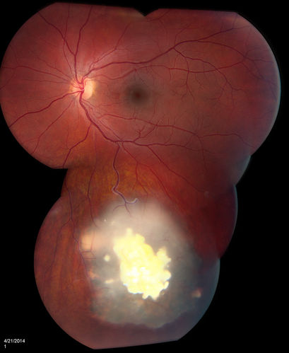 Retinoblastoma
Young male who has a retinal tumor inferior with a calcium core in the left eye. This is a regressed retinoblastoma. 
Keywords: May2014
