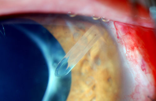 Ahmed Tube Placement
Patient with severe glaucoma is seen post op for ahmed tube placement. VA is 20/70 and IOP is 8 in the left eye. Patient is stable.
