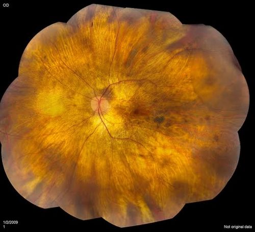 Keywords: dystrophy