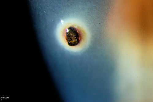Corneal Foreign Body 
Patient complains of foreign body sensation in the right eye. Slit lamp photos shows a piece of glass metal embedded into the inferior part of the cornea at 7-o'clock in the right eye. Foreign body was removed. 
