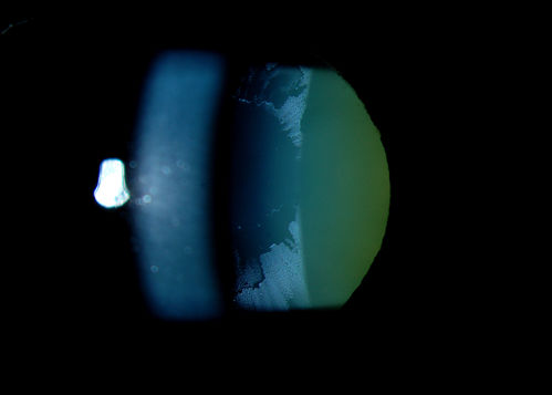 Severe Pseudoexfoliation Ring, Left Eye
Patient comes in for blurred vision. VA is 20/30 both eyes. Mostly at near which was corrected with refraction. Slit lamp photos show severe pseudoexfoliation in the left eye. Patient will be followed up for glaucoma eval in a few weeks. 
