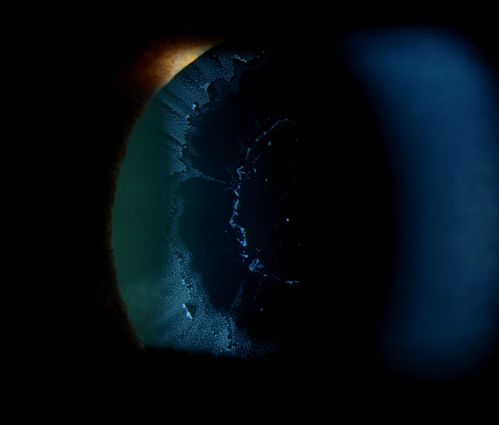 Severe Pseudoexfoliation Ring, Left Eye
Patient comes in for blurred vision. VA is 20/30 both eyes. Mostly at near which was corrected with refraction. Slit lamp photos show severe pseudoexfoliation in the left eye. Patient will be followed up for glaucoma eval in a few weeks. 

