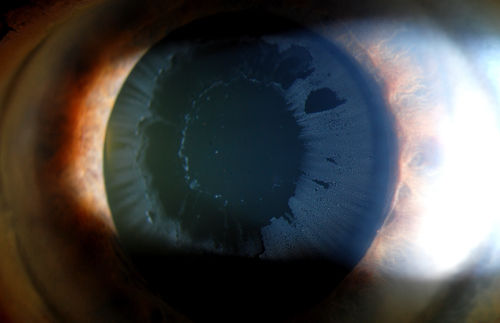 Severe Pseudoexfoliation Ring, Left Eye
Patient comes in for blurred vision. VA is 20/30 both eyes. Mostly at near which was corrected with refraction. Slit lamp photos show severe pseudoexfoliation in the left eye. Patient will be followed up for glaucoma eval in a few weeks. 

