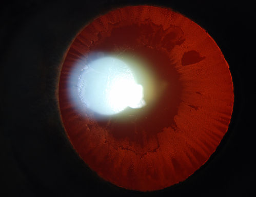 Severe Pseudoexfoliation Ring, Left Eye
Patient comes in for blurred vision. VA is 20/30 both eyes. Mostly at near which was corrected with refraction. Slit lamp photos show severe pseudoexfoliation in the left eye. Patient will be followed up for glaucoma eval in a few weeks. 
