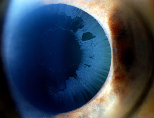 Severe Pseudoexfoliation Ring, Left Eye
Patient comes in for blurred vision. VA is 20/30 both eyes. Mostly at near which was corrected with refraction. Slit lamp photos show severe pseudoexfoliation in the left eye. Patient will be followed up for glaucoma eval in a few weeks. 
