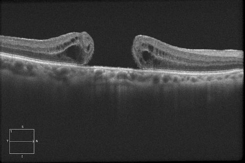 HD Grayscale OCT of Macular Hole
