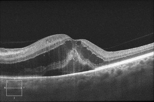Optic Neuritis/Neuroretinitis
Pt. states lost some vision in his left eye last week, was seen by eye MD and referred for eval.  Also complains of pain in left eye with eye movement. VA was 20/400 in the left eye. Fundus photo and HD-OCT imaging show optic nerve swelling and fluid underneath the retina. Will consult with Neuro-Ophthalmologist for further evaluation.


