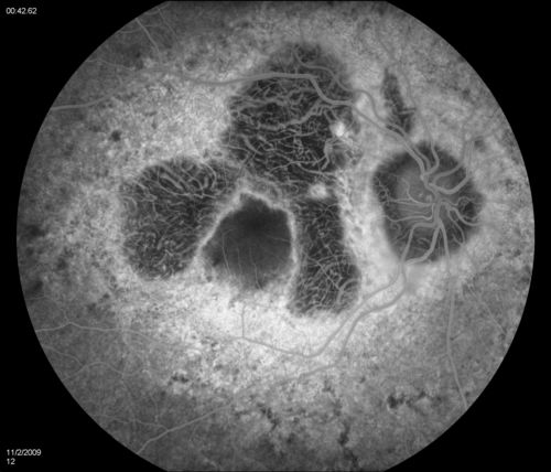 Alphamethlyacyl COA Racemase Deficiency
