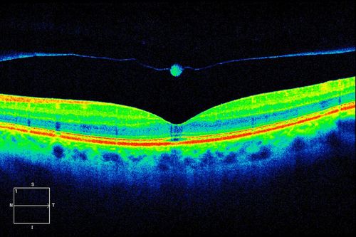 HD OCT Image of Operculum

