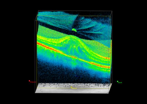 OCT of Macular Hole with Operculum
OCT of macular hole in 3-D with Tractional maculopathy. Operculum is present
Schlüsselwörter: macular hole