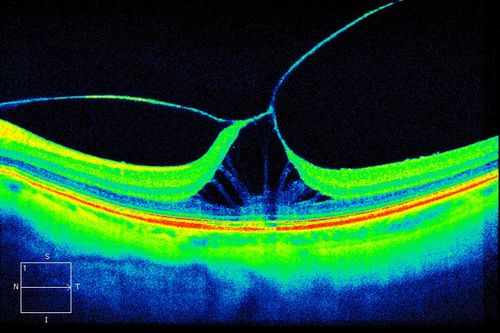 Symptomatic Vitreomacular Traction
Patient comes in with loss of light reflection to the left eye. HD-OCT shows Symptomatic Vitreomacular Traction to the left eye. Patient was injected with Jetrea and will be seen back in 2-weeks for follow-up. 
