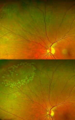 Retinal Tear with Laser Treatment
Patient comes in with blurry vision and mild floaters in the left eye. Fundus photo shows retinal tear with fluid present in the superior nasal quadrant of the left eye. Laser Retinopexy was performed to fix the retinal tear. 

