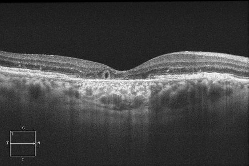 Outer Retinal Tubulation
Patient with a history of wet macular degeneration and glaucoma in both eyes. VA is 20/50, right eye, 20/80, left eye. Patient is treated with Eylea in both eyes. Enhanced Depth Imaging OCT reveals a small like form of a cyst which in fact isn't a cyst at all. This is called Outer Retinal Tubulation in which degenerating photo-receptors may become arranged in a circular or ovoid fashion. This is sometimes misdiagnosed as cystic changes in the retinal pigment epithelium or sub-retinal fluid. 
