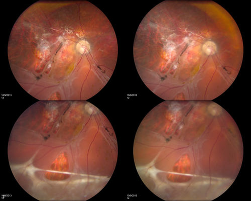 Rhegmatogenous Retinal Detachment
Patient comes in for second opinion on RD, right eye. VA is NLP in the right eye. Fundus photography shows inferior retinal detachment with holes and subretinal fibrosis. No further surgery is suggested at this time. 
