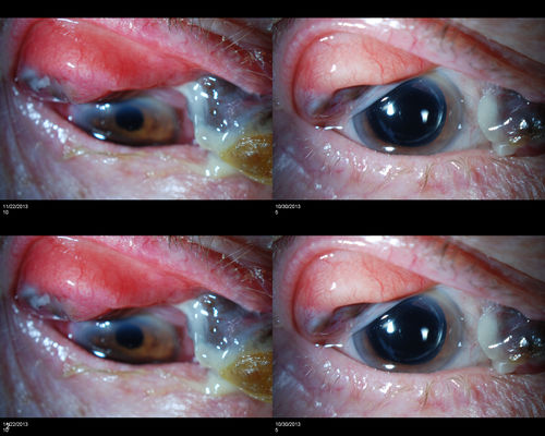 Conjunctival Melanoma
Right conjunctival melanoma extending into anterior orbit, right eye. Temporally and nasally with pigmented masses/nodules. VA was 20/30 without correction in the right eye. Follow up to proceed with proton beam therapy.
Keywords: november2013