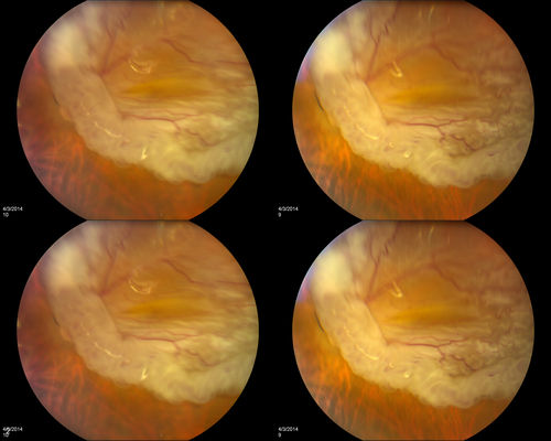 Large Retinal Detachment with PVR
Patient with poor vision in the left eye. Fundus photography shows rhegamatogenous retinal detachment with proliferative vitreoretinopathy in the left eye. Silicone oil is also present in the left eye. 

