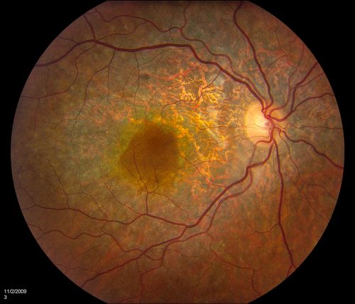 Choroidal Melanoma with Retinal Detachment
Choroidal Melanoma centering off the optic nerve with retinal detachment inferiorly in the right eye. 
