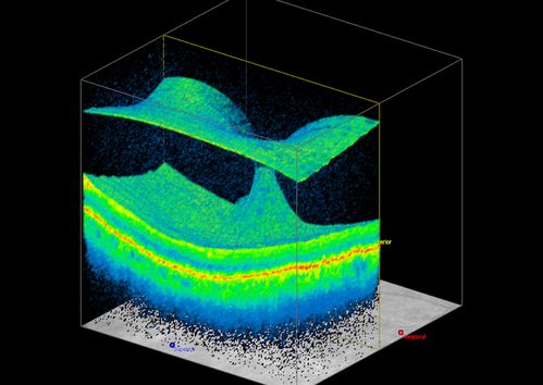 3-D OCT Image of Tractional Maculopathy
