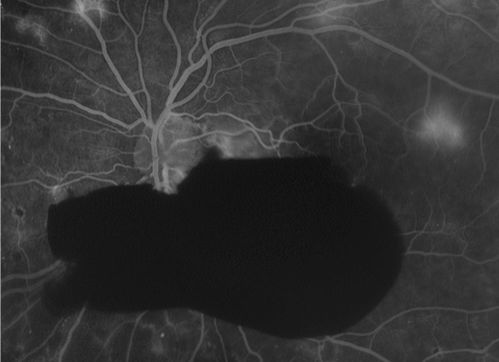 Angiogram of PDR and subhyloid hem
Keywords: Angiogram of PDR;subhyloid hem