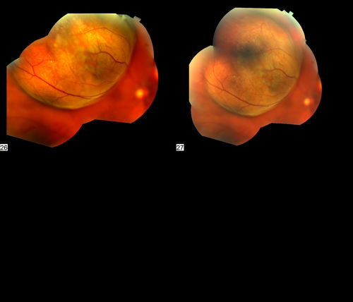 Malignant Melanoma
60 year old woman presents with obscured vison in the right eye. Diagnosed with Malignant Melanoma. 
Keywords: Malignant Melanoma
