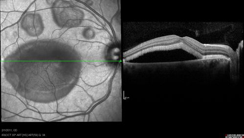 Acute Multifocal Vitelliform Exudative Maculopathy Right Eye At 1 Mo Follow Up
Keywords: march2013