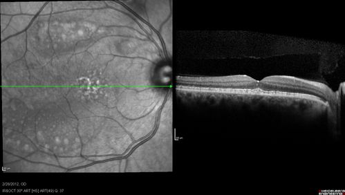 Acute Multifocal Vitelliform Exudative Maculopathy Right Eye At 6 Mo Follow Up
