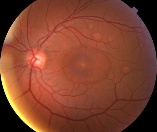 Acute Multifocal Vitelliform Exudative Maculopathy Left Eye
41 yr old male with decreased central vision 10 days OU 

Keywords: march2013
