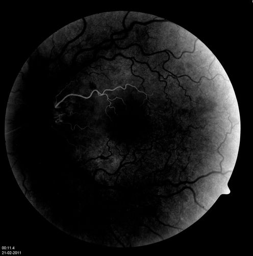 Corresponding FA
Corresponding FA for Cilioretinal artery occlusion with early venous stasis retinopathy - early
