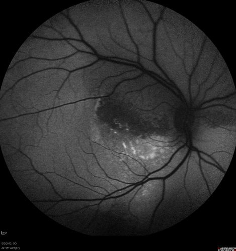 autofluorescence. od
autofluorescence helps localize the subretiinal fluid
