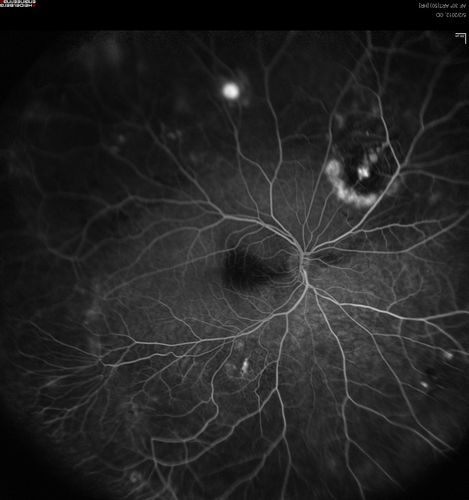 wide angle fa mid. od
leaking, abnormal vessels
