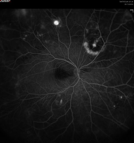 wide angle fa late. od
leaking vessels
