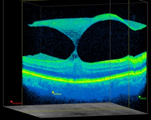 VMT 3D
Vitreous Macular Traction in 3D
Keywords: Vitreous Macular Traction;VMT;Macular Pucker;MP