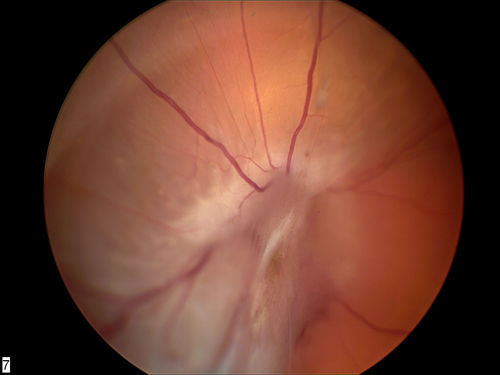 RD with PVR
RD with Proliferative Vitreoretinopathy 
Keywords: RD;PVR;Proliferative Vitreoretinopathy;february2013