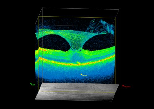 VMT 3D
Vitreous Macular Traction in 3D
Võtmesõnad: Vitreous Macular Traction;VMT;Macular Pucker;MP