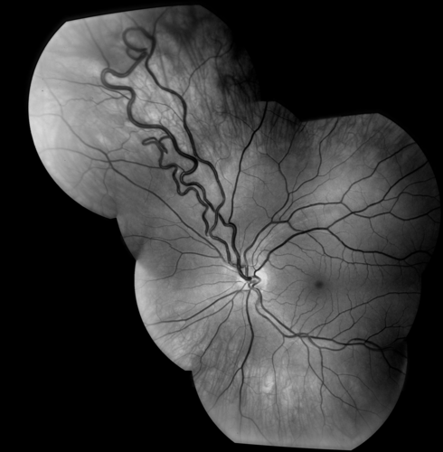 AVM
RF of AVM in OS of a 48 yr old female.
Keywords: AVM;Arteriol Venous Malformation