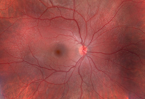 Cone Rod Dystrophy
Cone Rod Dystrophy in OD of seven year old girl
Keywords: Dystrophies;Cone Rod;january2013