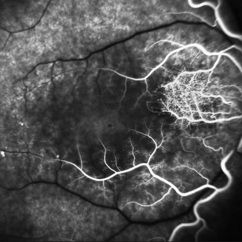 CRAO
CRAO in OD of a 37 yr old Male, Transit Phase
Keywords: CRAO, Central Retinal Artery Occlusion