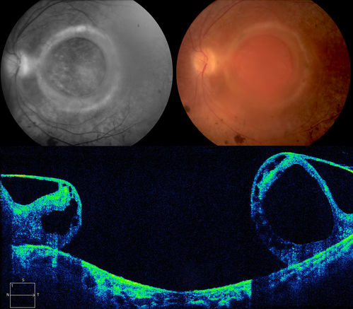 Macular Hole
A Large Full Thickness Macular Hole in OS of a middle aged female.
Keywords: Macular  Hole;MH;Full Thickness Macular Hole;FTMH