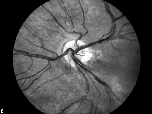 FEVR in OS of a 14 yr old girl
Palabras clave: FEVR;Familial Exudative Vitreoretinopathy