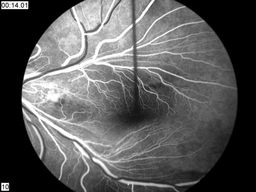 FEVR FA Transit
FEVR in OS of a 14 yr old girl
Palabras clave: FEVR;Familial Exudative Vitreoretinopathy